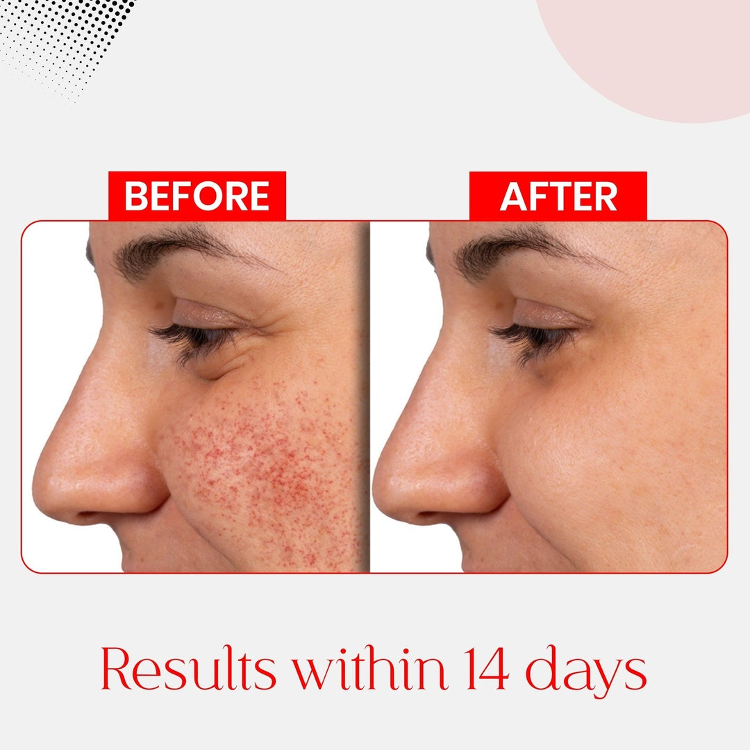 Anti Pigmentation Bundle