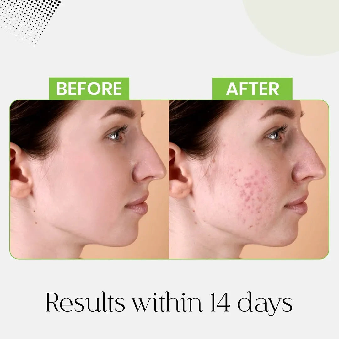 Anti Acne Bundle
