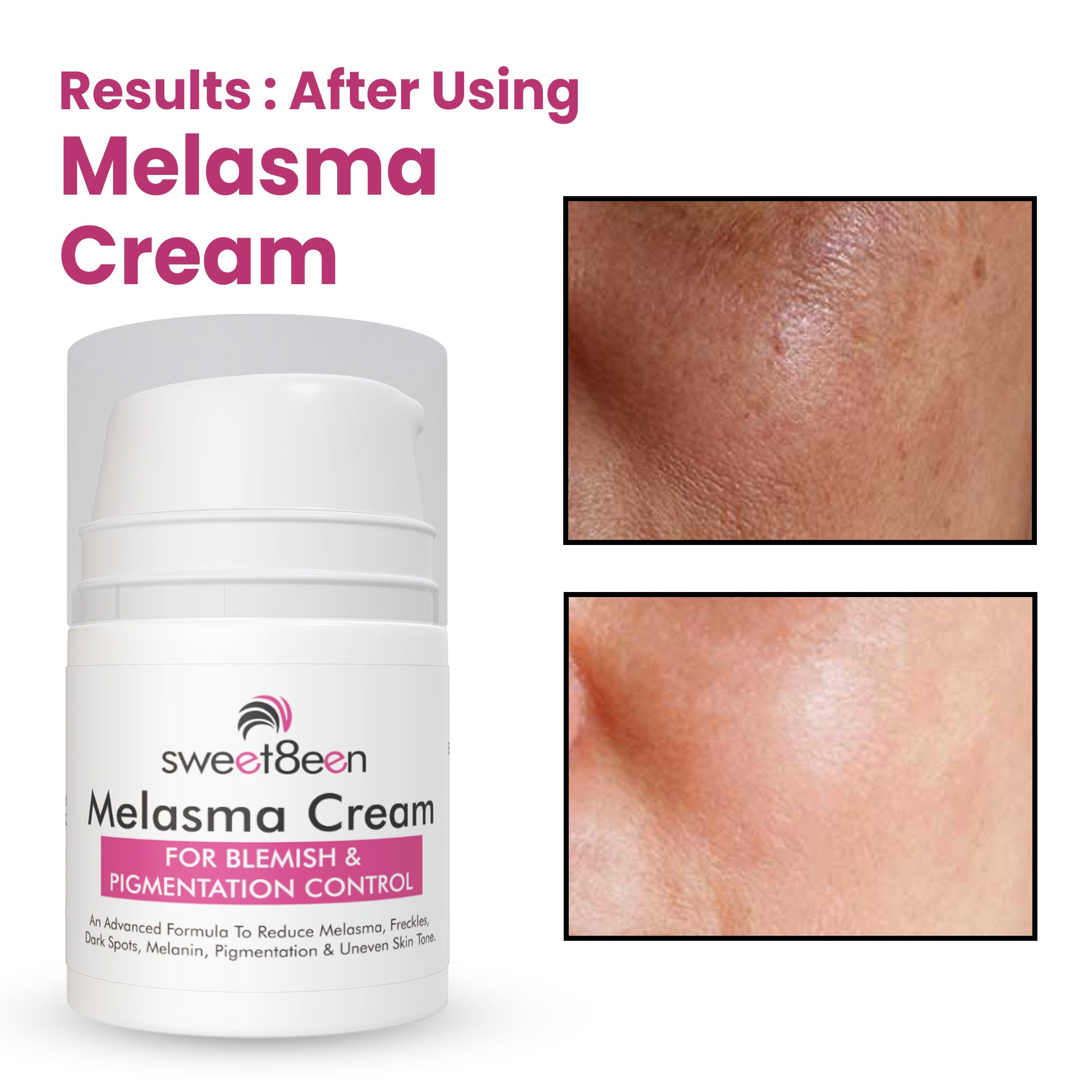 MELASMA CREAM